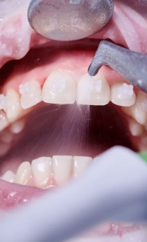 oral hygiene procedure