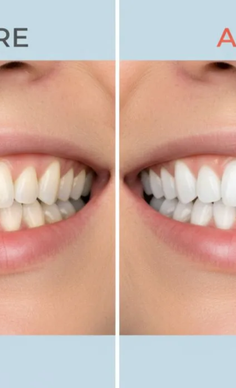 how long does teeth whitening last