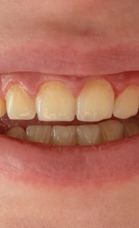 What is Teeth Scaling