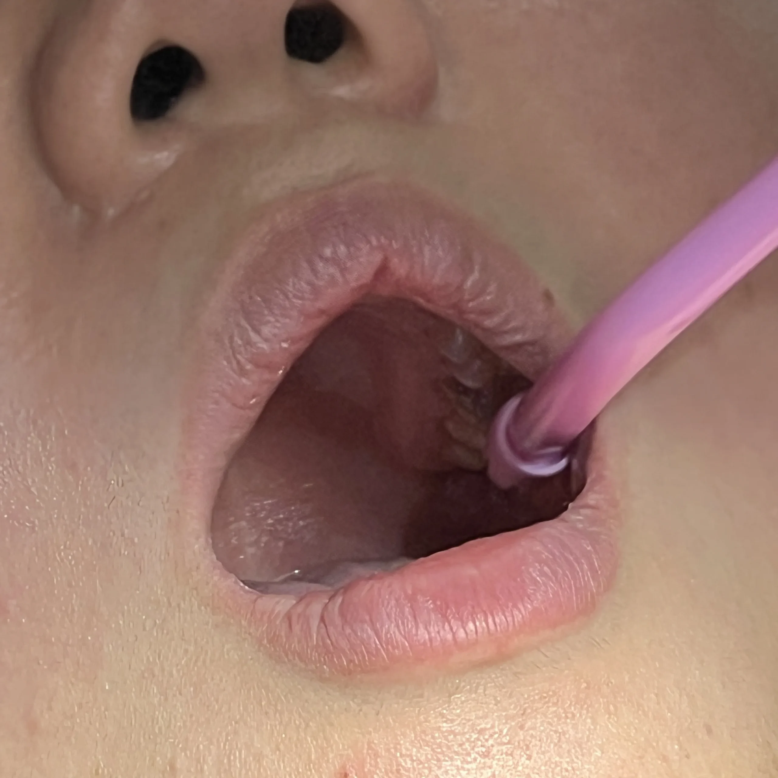 Dental Coating in Burnaby